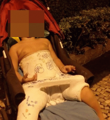 Criança foi agredida por Doutor Jairinho, segundo a polícia. Foto, de 2015,mostra menino engessado após ter fraturado o fêmur - Reprodução