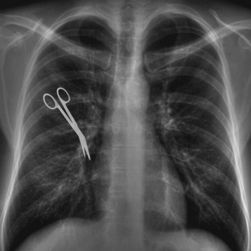 Tesoura encontrada em Raio-X de paciente.