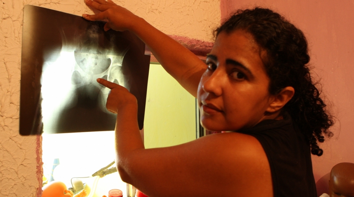 Jovem tem osso da bacia quebrado durante procedimento de parto em hospital de Nova Iguaçu,na baixada.