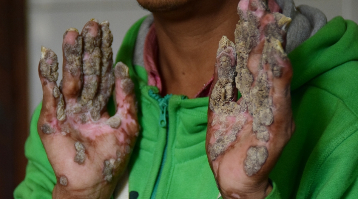 Abul Bajandar, conhecido como Homem Árvore, passou pela 25ª operação para tratar síndrome que provoca verrugas que parecem cascas de árvore. Há um ano ele foi declarado curado dessa rara síndrome, mas recaída faz refletir que caso é mais complicado do que se imaginava 