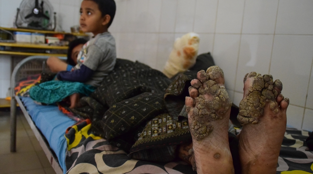 Abul Bajandar, conhecido como Homem Árvore, passou pela 25ª operação para tratar síndrome que provoca verrugas que parecem cascas de árvore. Há um ano ele foi declarado curado dessa rara síndrome, mas recaída faz refletir que caso é mais complicado do que se imaginava 