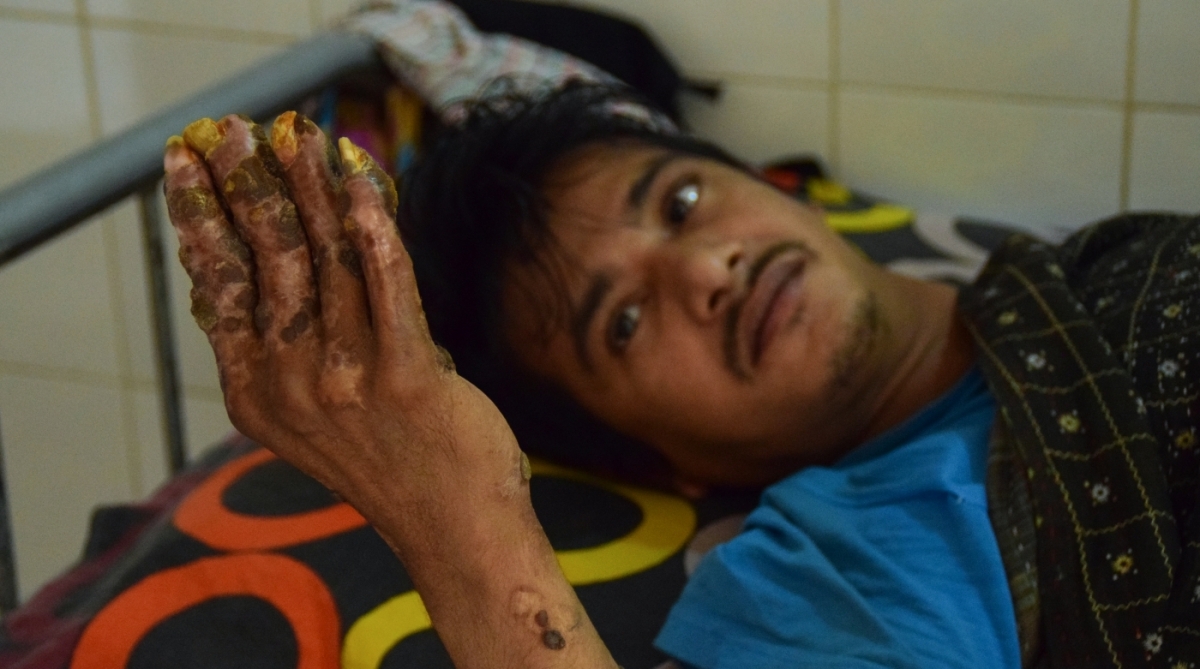 Abul Bajandar, conhecido como Homem Árvore, passou pela 25ª operação para tratar síndrome que provoca verrugas que parecem cascas de árvore. Há um ano ele foi declarado curado dessa rara síndrome, mas recaída faz refletir que caso é mais complicado do que se imaginava 