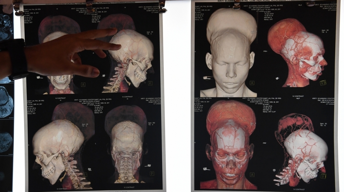 Radiografia do tumor