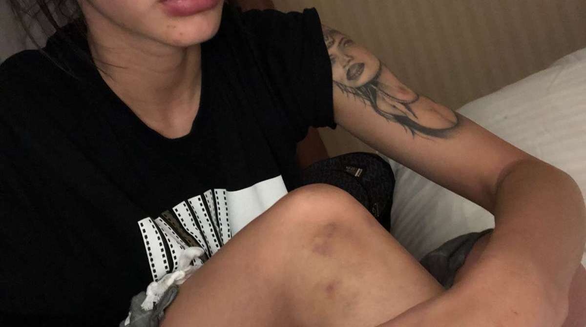 Duda Castro com marcas de agressão