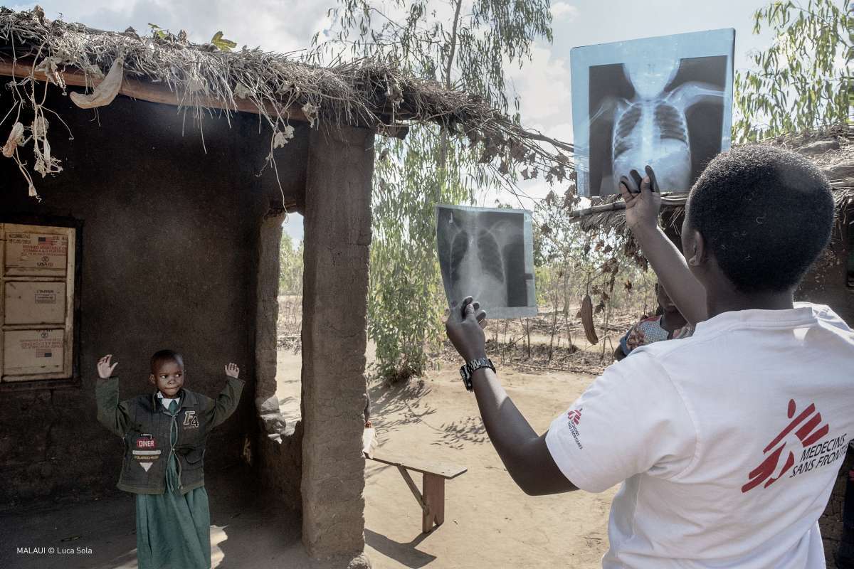 Atendimento de tuberculose em Malawi - Luca Sola