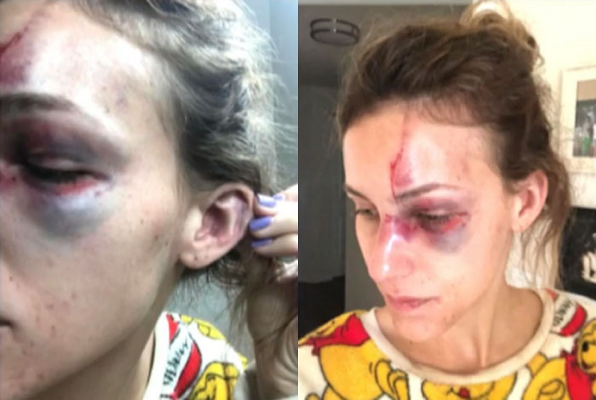 Melissa compartilhou os graves ferimentos provocados por Erick  - Reprodução 