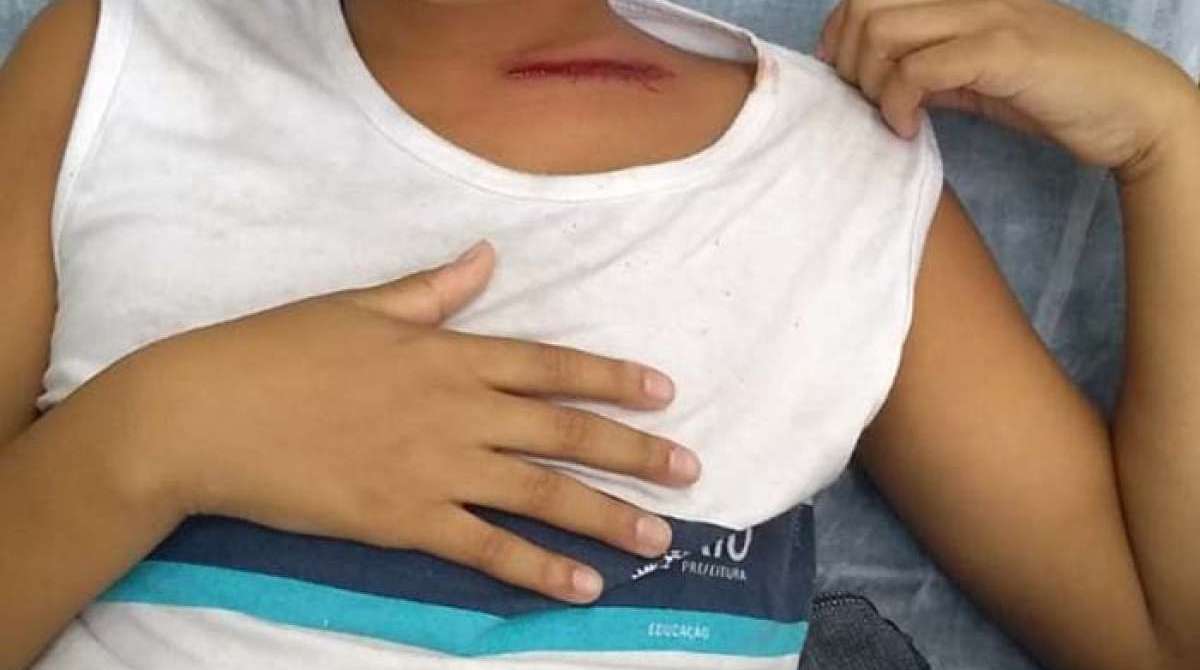 O aluno de 11 anos mostra onde foi atingido pela bala perdida
