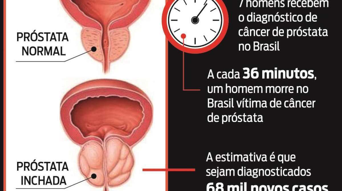 Infografias mostram dados sobre o câncer de próstata no país