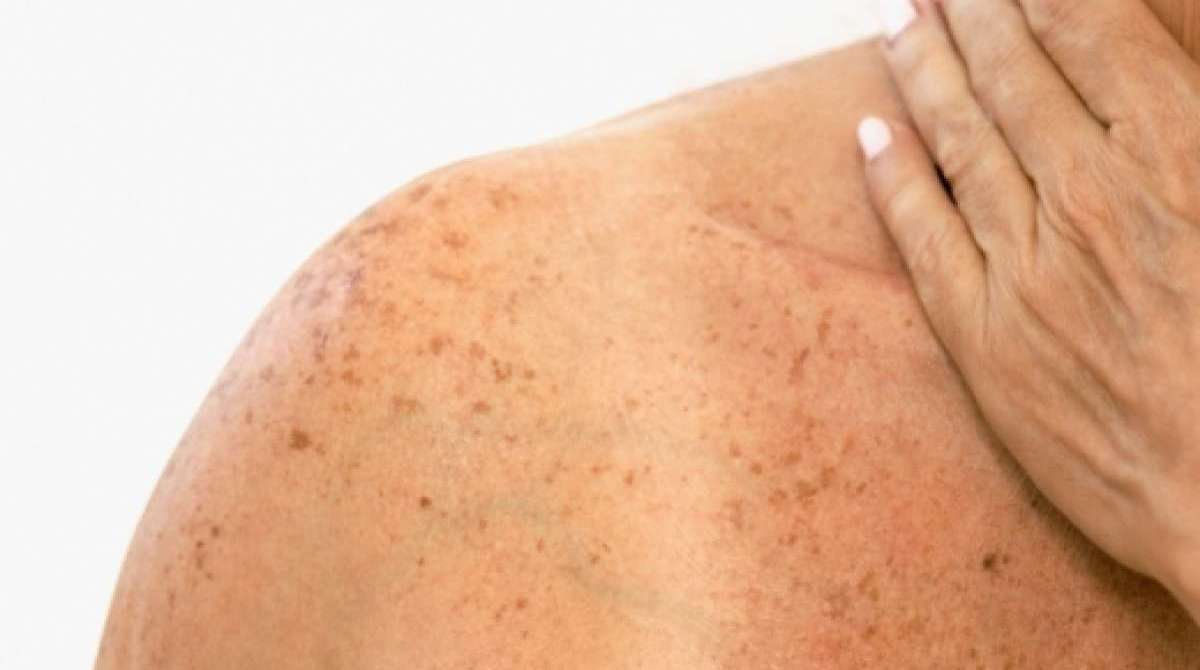 Manchas na pele podem representar risco de câncer