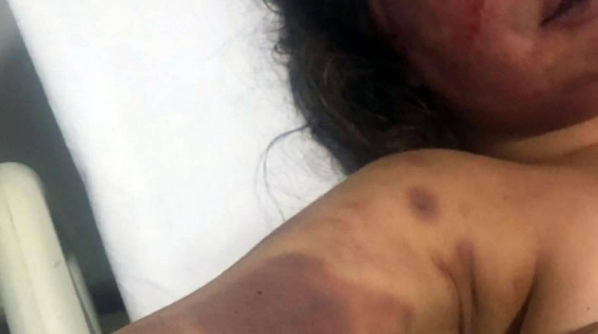Elaine ficou com vários hematomas pelo corpo