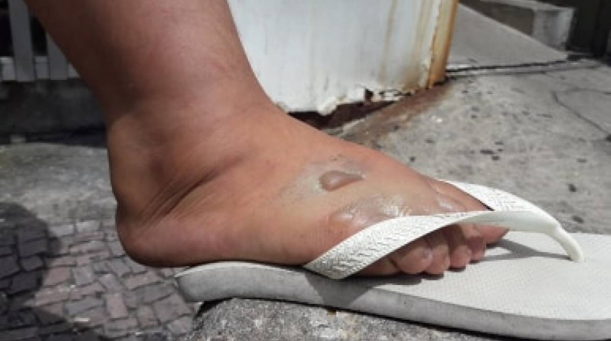 Thaís Antunes, de 19 anos, ficou com o pé queimado na correria na hora do tiroteio. O marido dela, André Luiz Lima de Oliveira, de 20 anos, teve o corpo queimado ao cair na fritadeira com óleo fervente - Estefan Radoviz / Agência O Dia