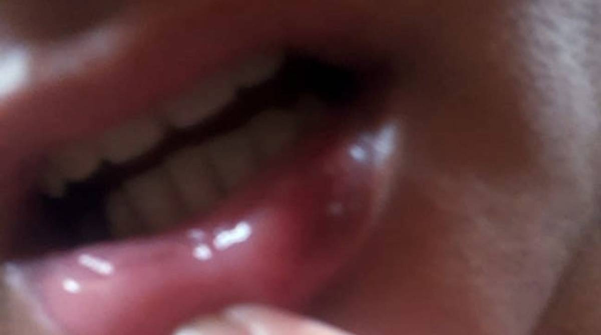 A professora tem várias marcas de agressões espalhadas pelo corpo