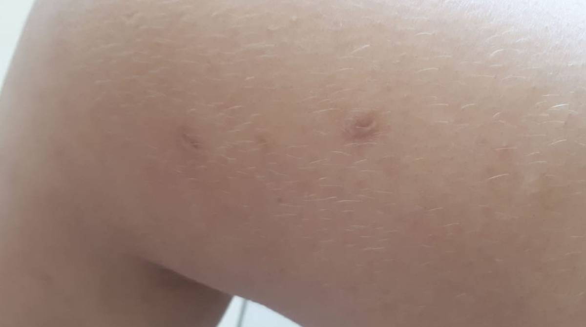 A professora tem várias marcas de agressões espalhadas pelo corpo