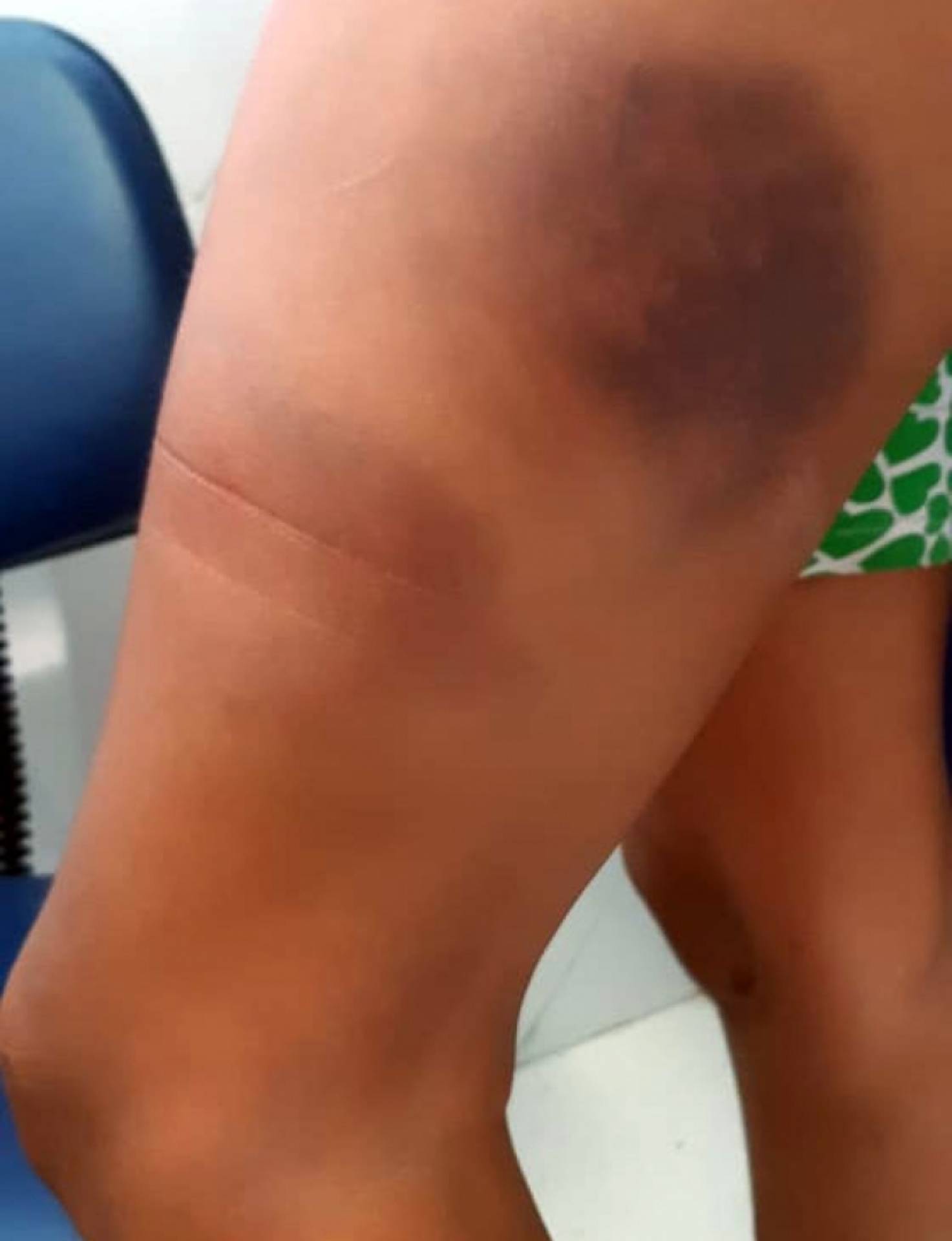A vítima ficou com muitas marcas pelo corpo