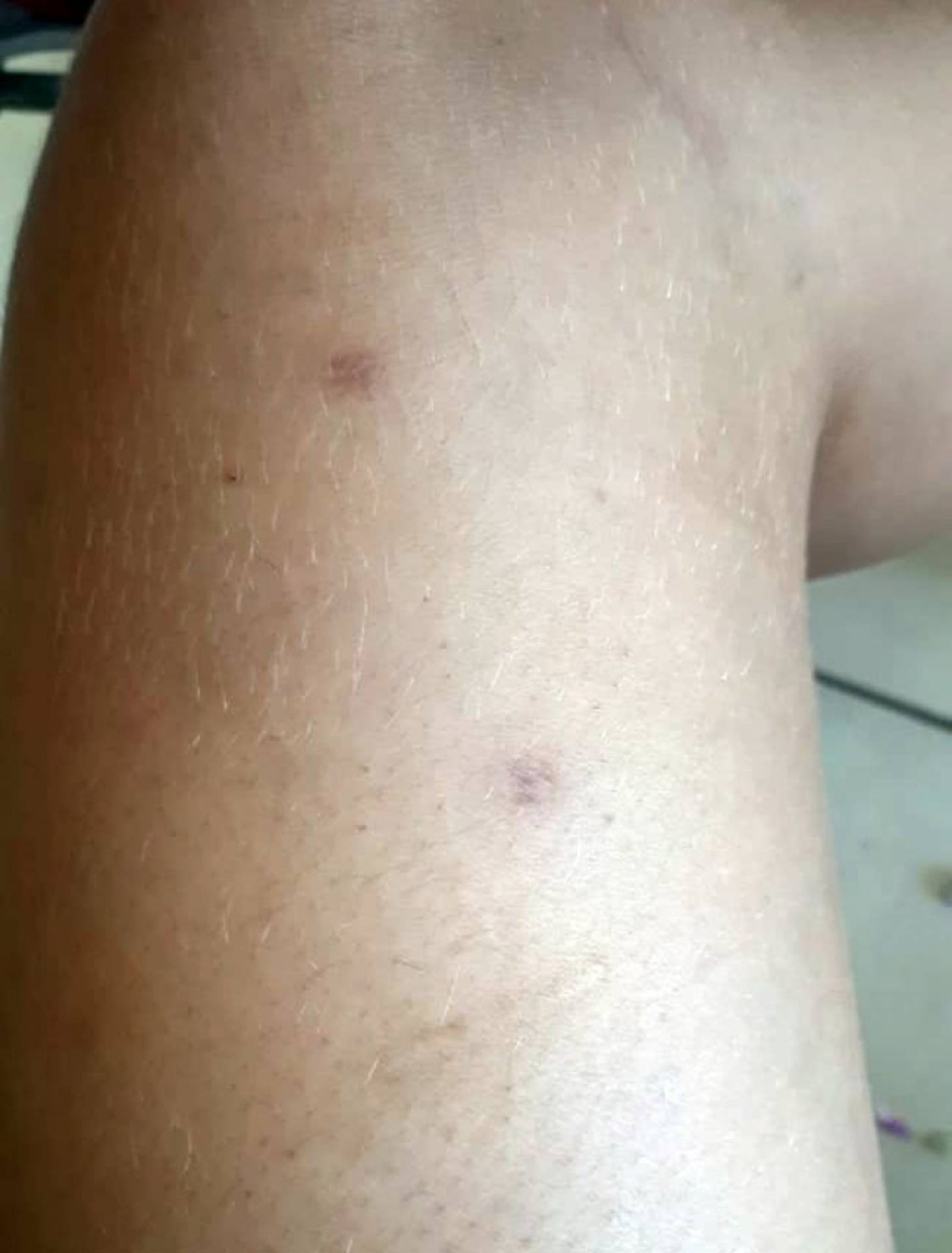 A professora tem várias marcas de agressões espalhadas pelo corpo