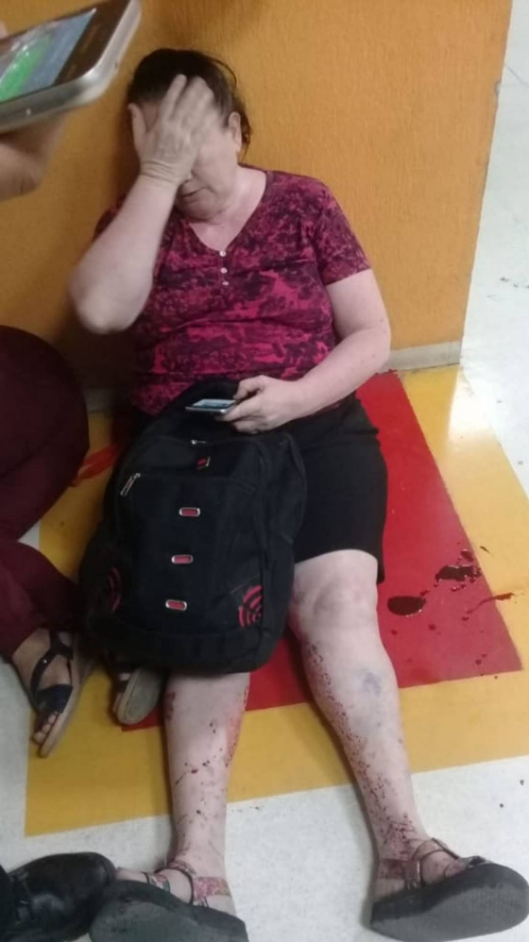 Dinalva Medeiros Santiago, de 53 anos, foi atingida na perna esquerda