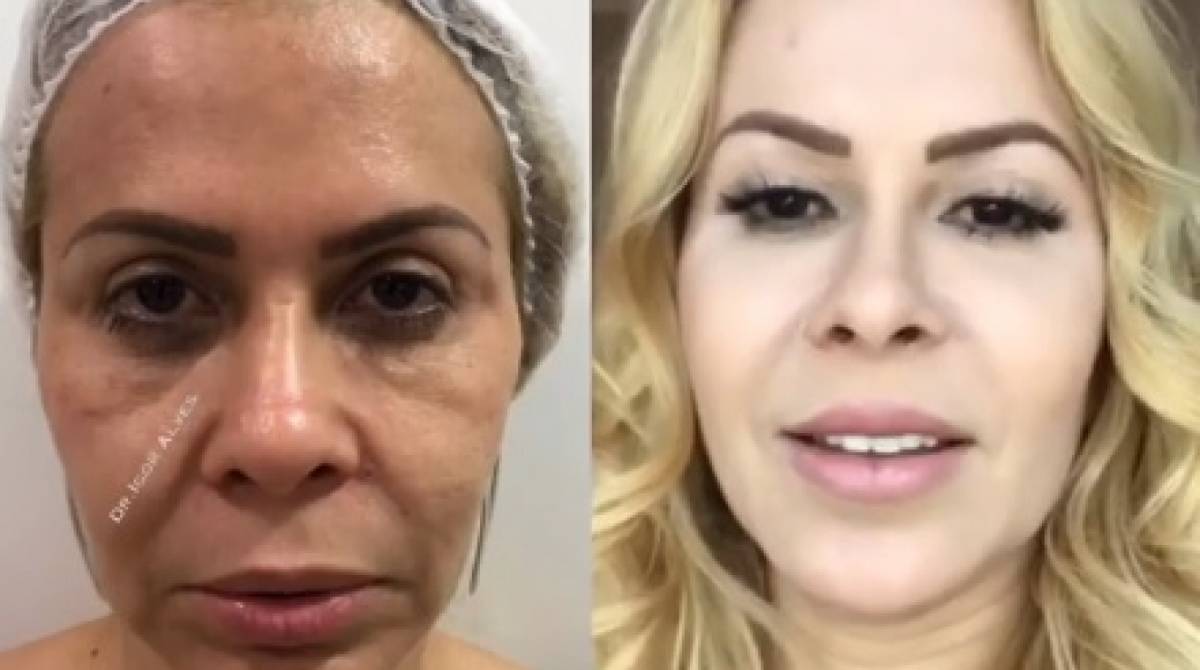 Joelma mostrou antes e depois de harmonização facial aos seguidores