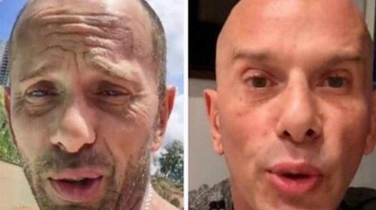 Antes e depois: Rafael Ilha aplica botox e faz harmoniza&ccedil;&atilde;o facial