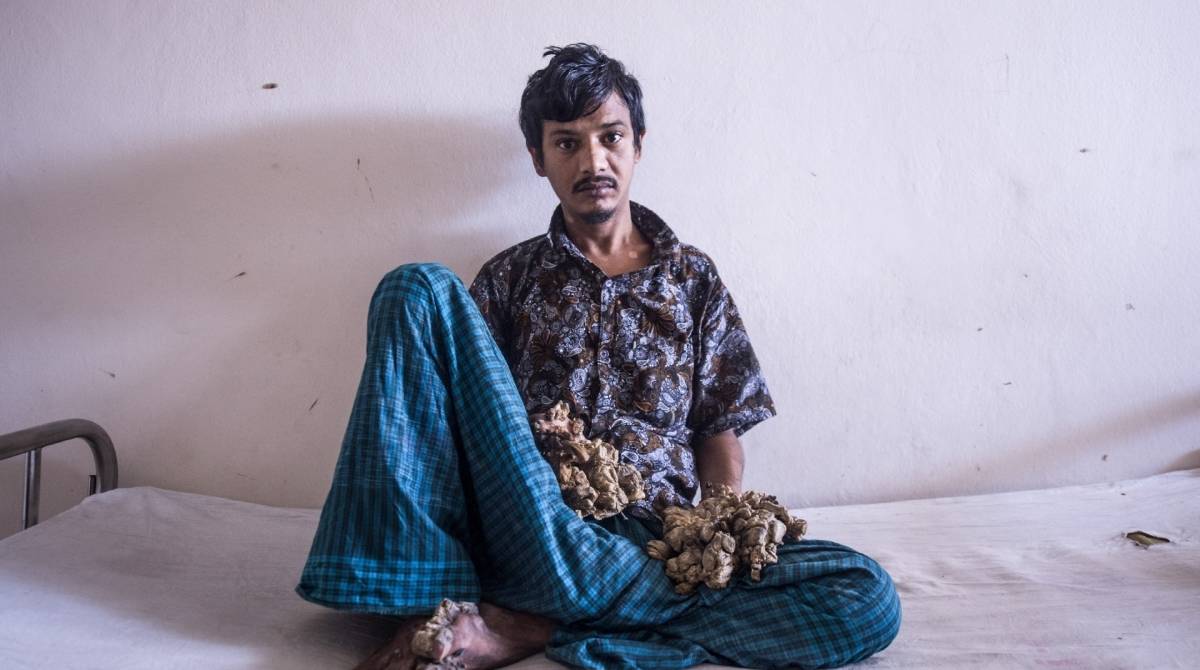Abul Bajandar, 28 anos, apelidado de 'homem-árvore' por verrugas enormes nas mãos e nos pés,no Dhaka Medical College, em Dhaka