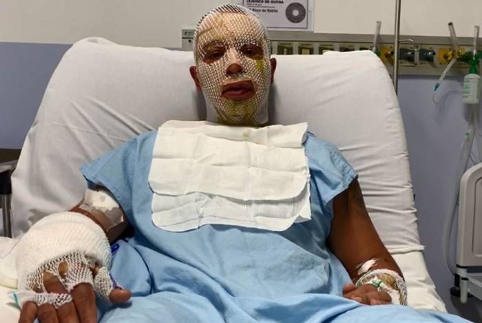 'Poderia ter sido fatal', diz prefeito de Osasco após sobreviver à explosão de fogueira em festa junina