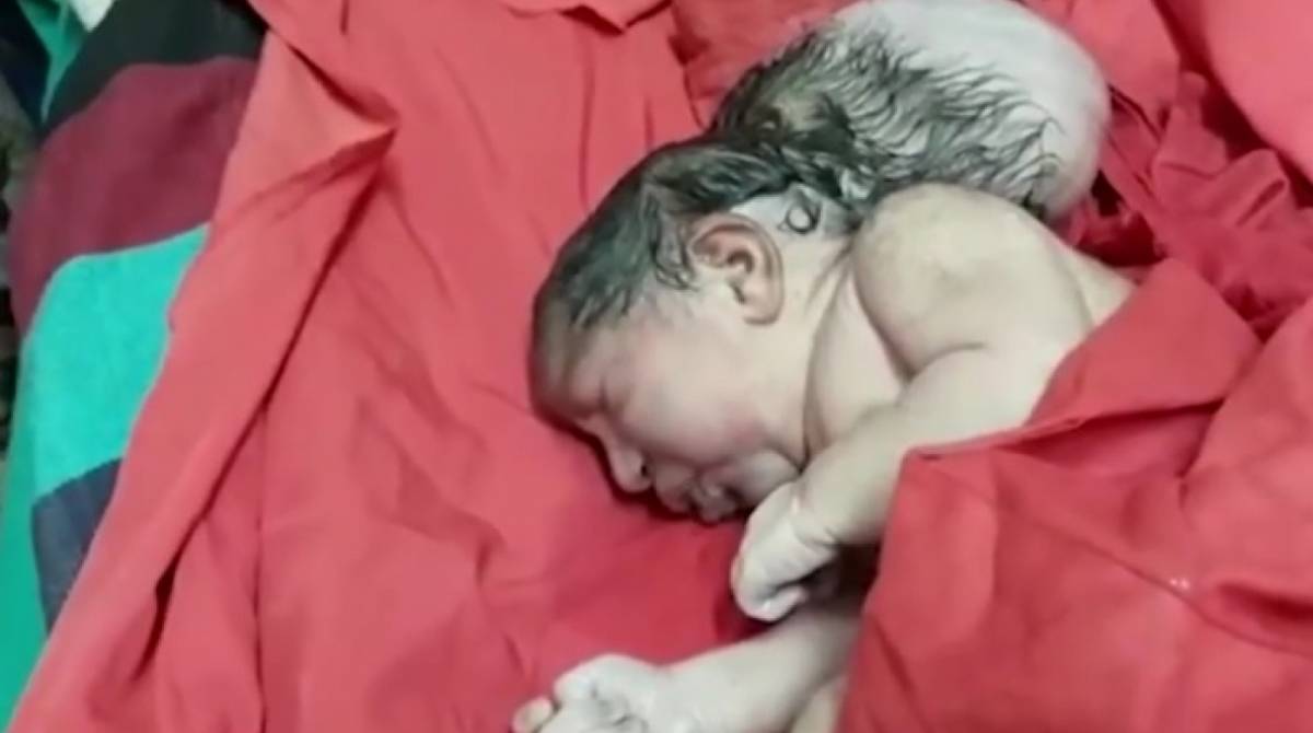 Bebê nasceu com três cabeças