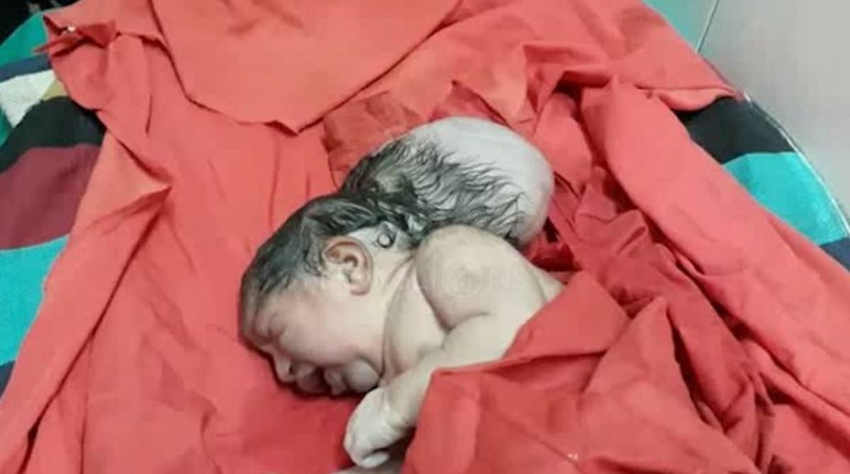 Bebê nasceu com três cabeças