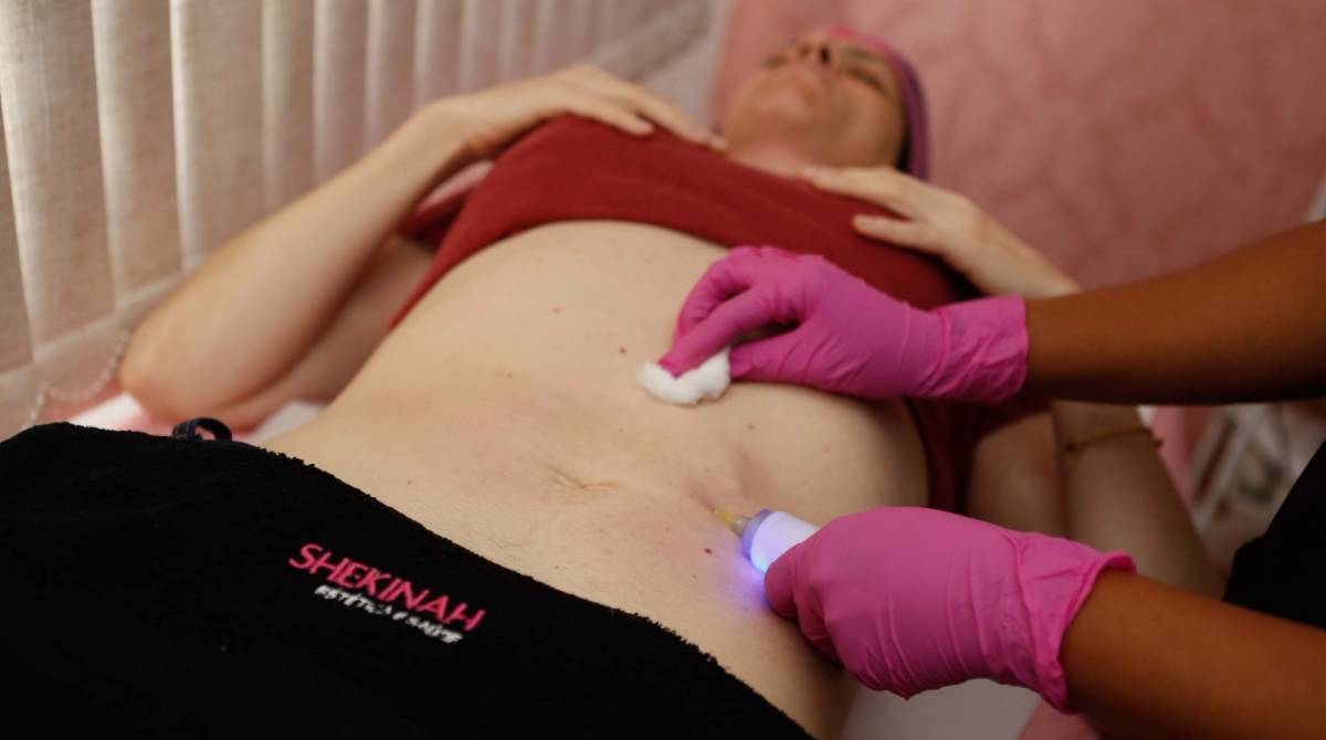 S&atilde;o Joao de Meriti, 29/07/2019, procedimentos esteticos, na foto a cliente Simone freitas, Foto de Gilvan de Souza / Agencia O Dia