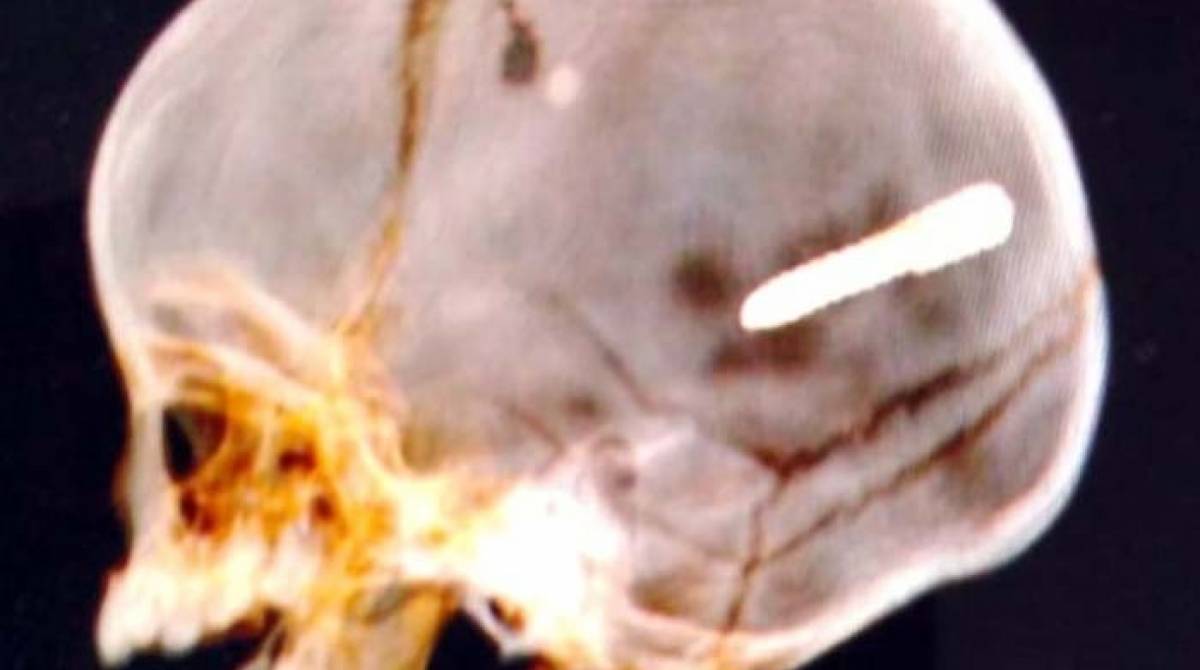 Exame de imagem constatou objeto alojado na cabeça do bebê - REPRODUÇÕES/WhatsApp