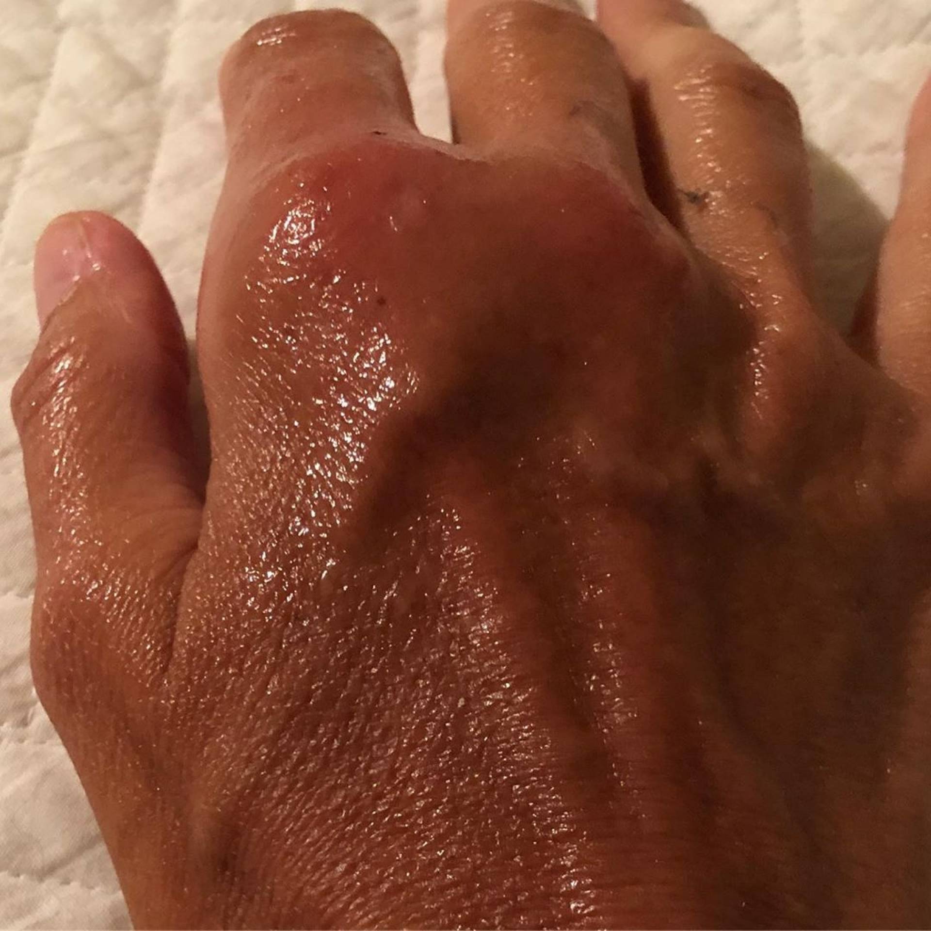 Daniela Escobar quase perde a mão após ser mordida por gato de estimação