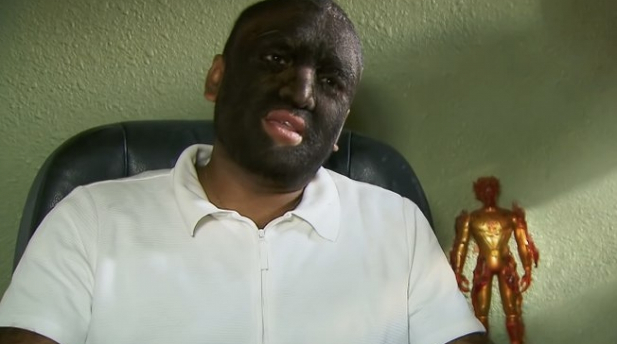 Larry Gomez, uma das cerca de 50 pessoas, em todo o mundo, com síndrome do lobisomem - Reprodução / Internet