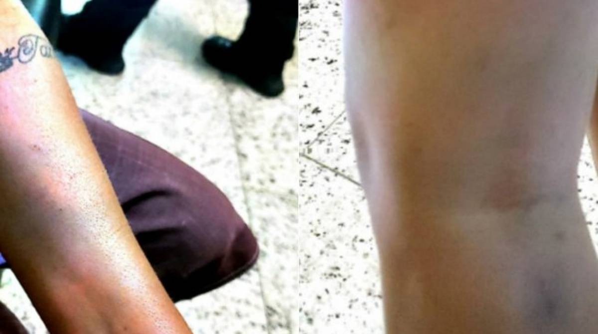 IML confirmou hematomas compatíveis com agressões sofridas pela mulher - Comissão de Direitos Humanos da OAB-GO / Divulgação