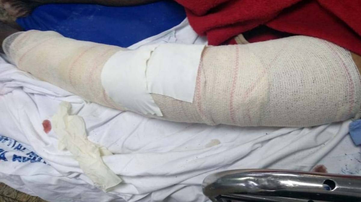 Idoso teve um fêmur fraturado