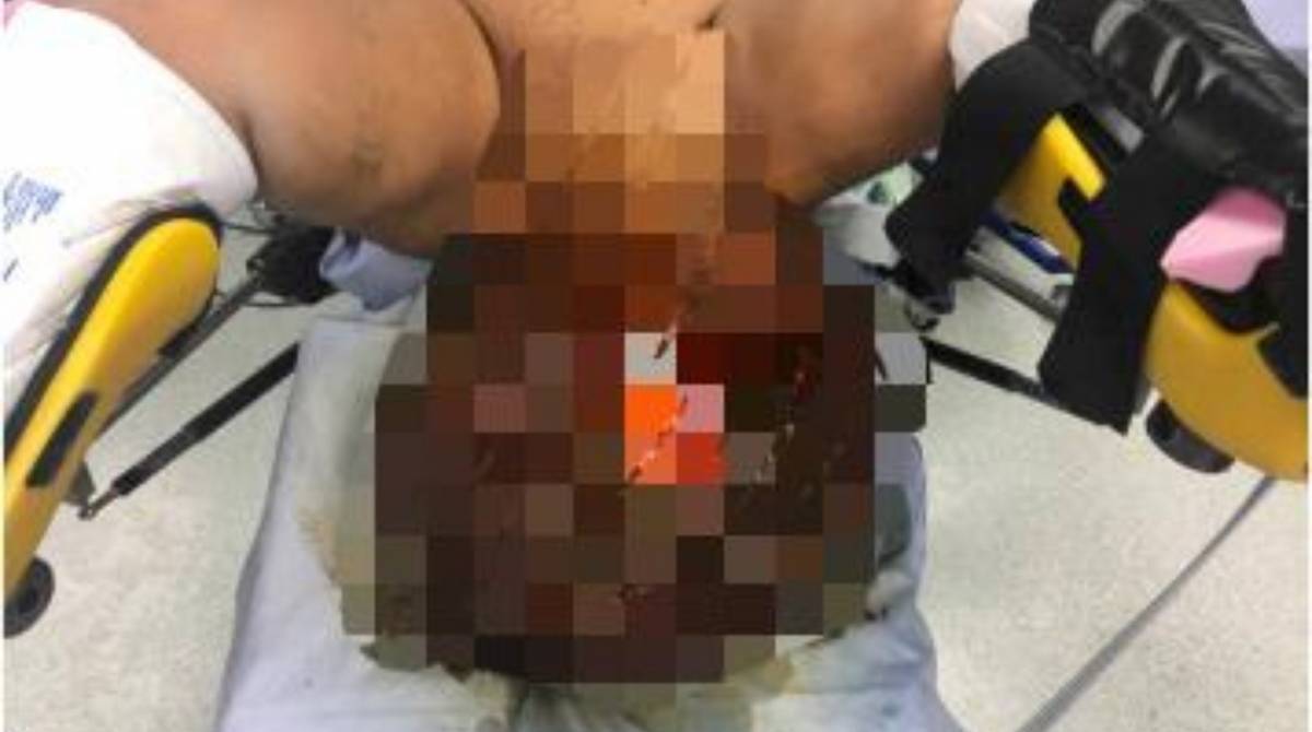 Apesar da condição bizarra, homem não visitava o médico há mais de 30 anos
 - Sciencedirect.com