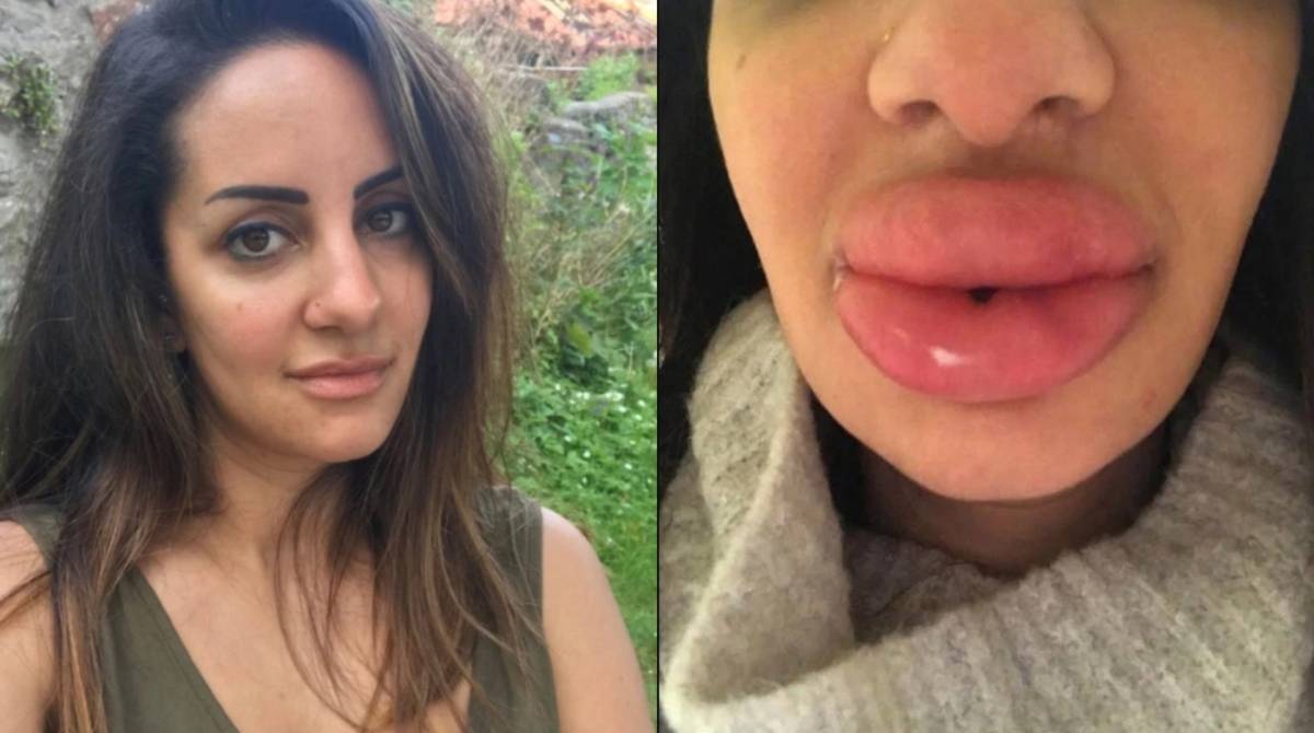 Sarah Najjar sonhava em fazer preenchimento labial, mas um erro no procedimento deixou sua boca inchada e dura - Reprodução/Facebook