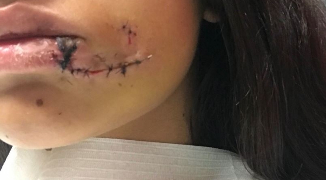 Jovem atacada por cachorro