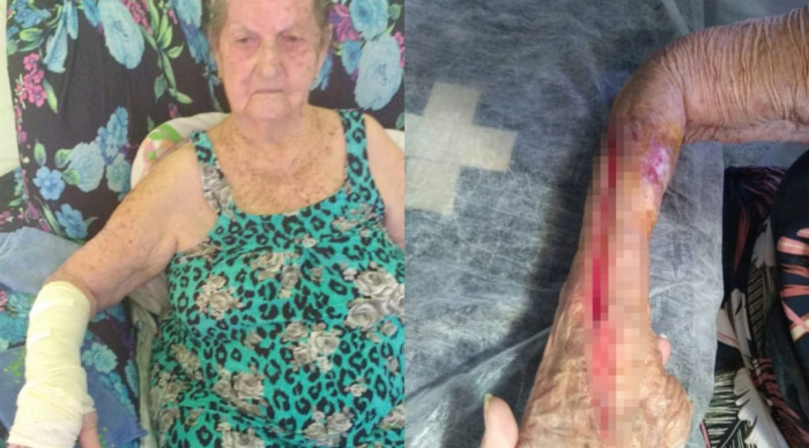 Idosa teve o braço cortado por funcionário do Rocha Faria quando retirava gesso - Reprodução Twitter