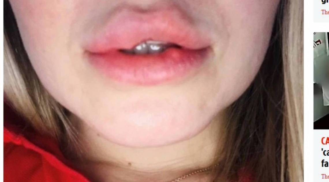 Michaela conta que a esteticista utilizou um produto &agrave; base de c&aacute;lcio ao inv&eacute;s de &aacute;cido hialur&ocirc;nico - Reprodu&ccedil;&atilde;o