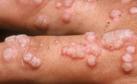 Caxias reforça campanha de vacinação contra vírus HPV