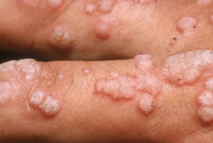 O HPV é um vírus que infecta a pele e as mucosas, causando lesões e dor em várias partes delicadas do corpo