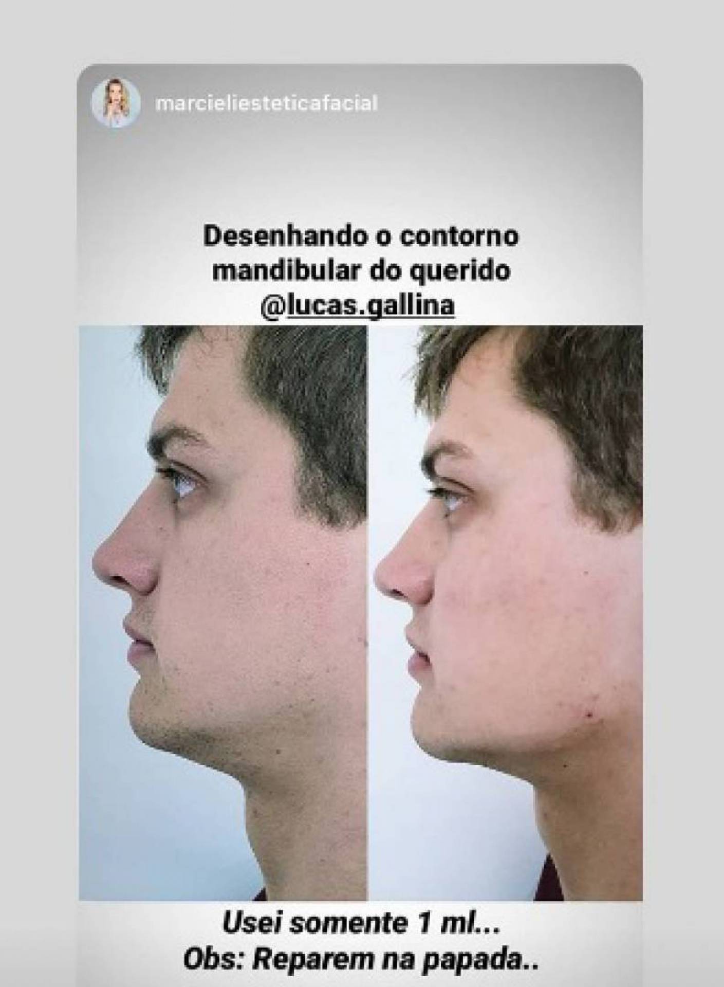 Preenchimento Mandibular Masculino com Antes e Depois