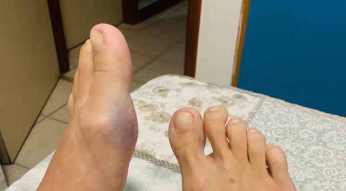 Anestesista ficou com marcas por todo o corpo