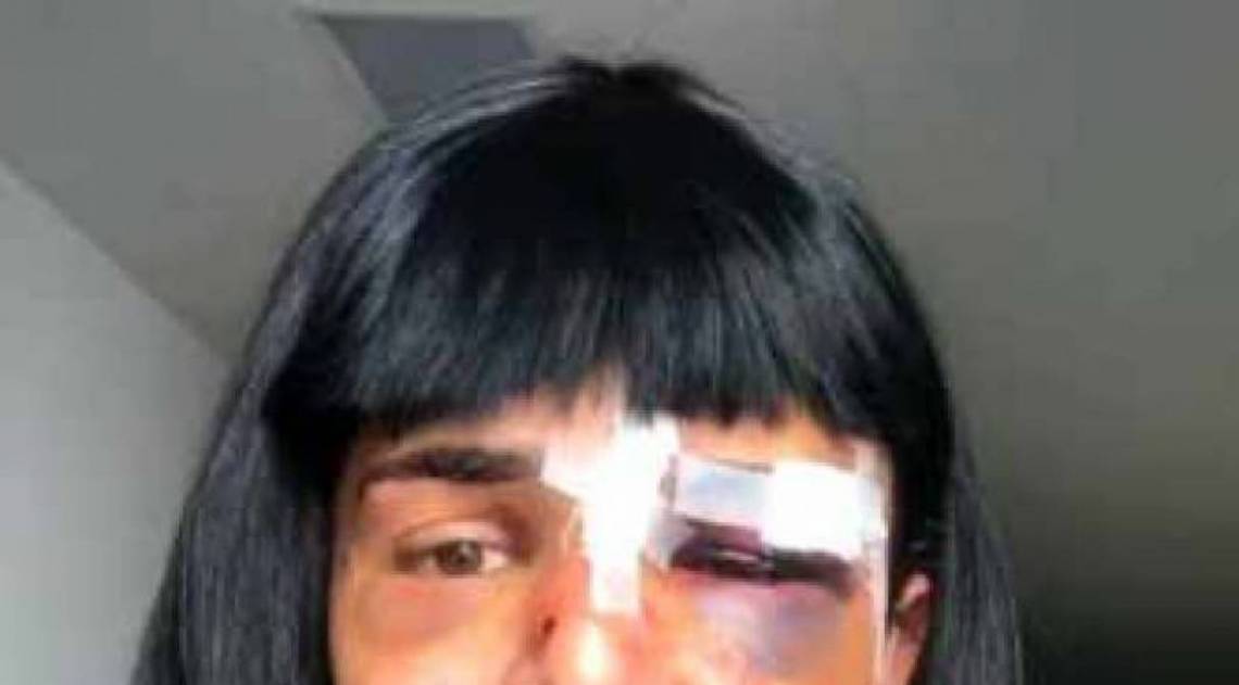 Alice Felis: v&aacute;rios hematomas