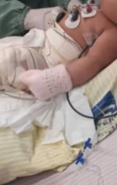 Beb&ecirc; teve 37,5% do corpo queimado - Arquivo Pessoal