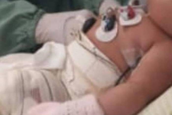 Morre beb&ecirc; que teve corpo queimado em hospital; enfermeira responder&aacute; por homic&iacute;dio