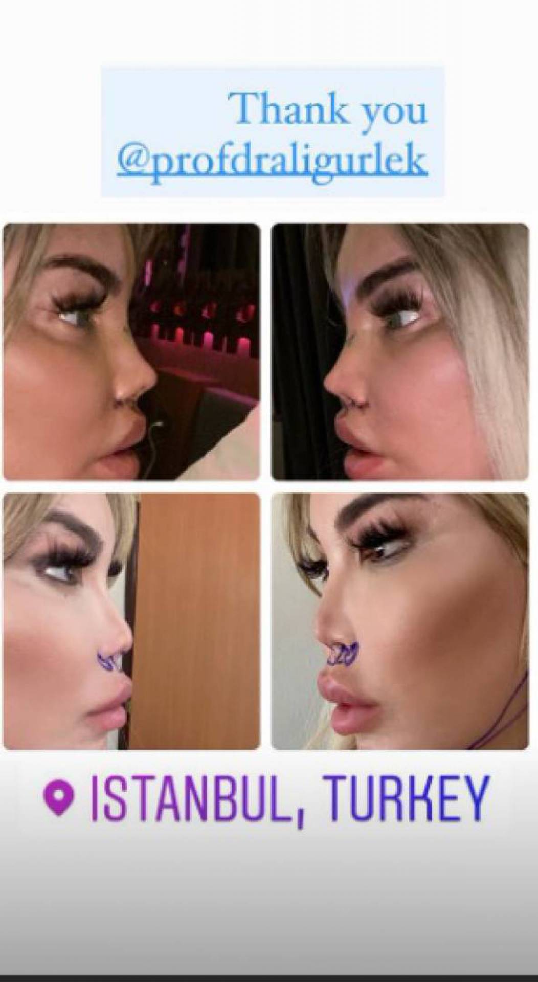 Novo nariz de Jéssica Alves