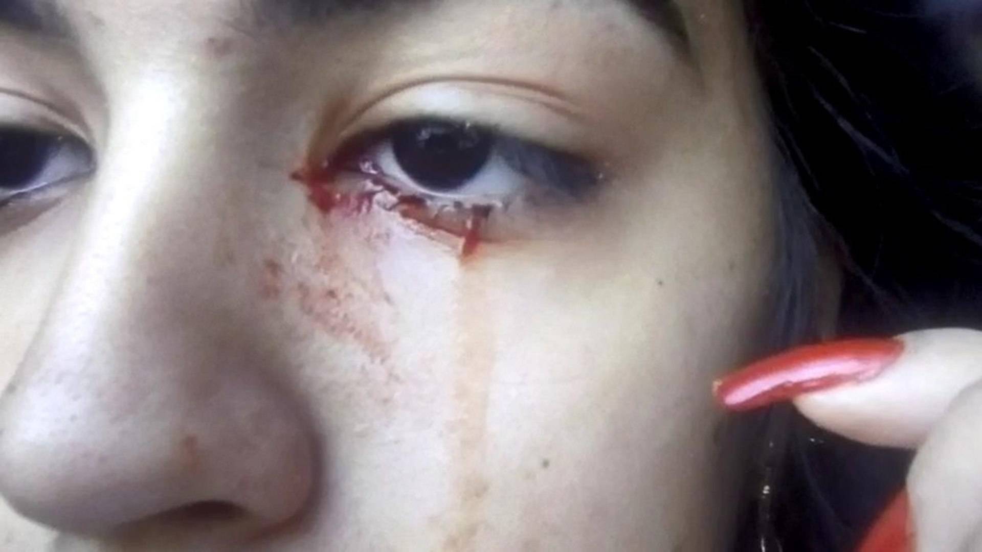 Adolescente de 15 anos chora sangue e intriga médicos; entenda