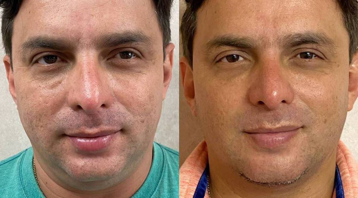 Esdras de Souza mostra o resultado da remo&ccedil;&atilde;o da papada