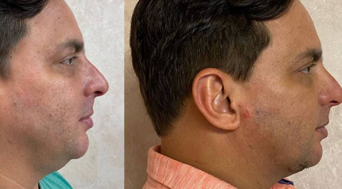 Esdras de Souza mostra o resultado da remo&ccedil;&atilde;o da papada