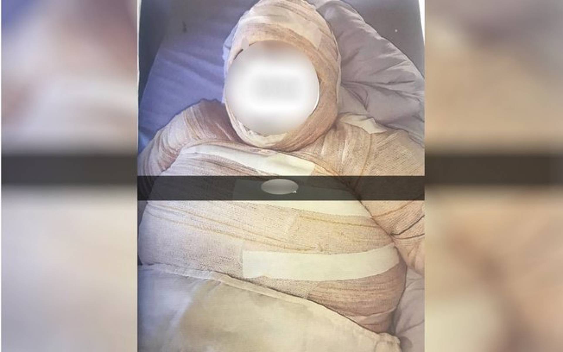 Mulher relatou que foi incendiada pela namorada