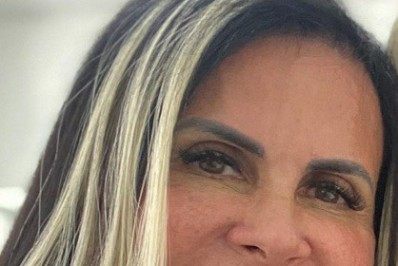 Gretchen mostra resultado de harmonização facial após uma semana
